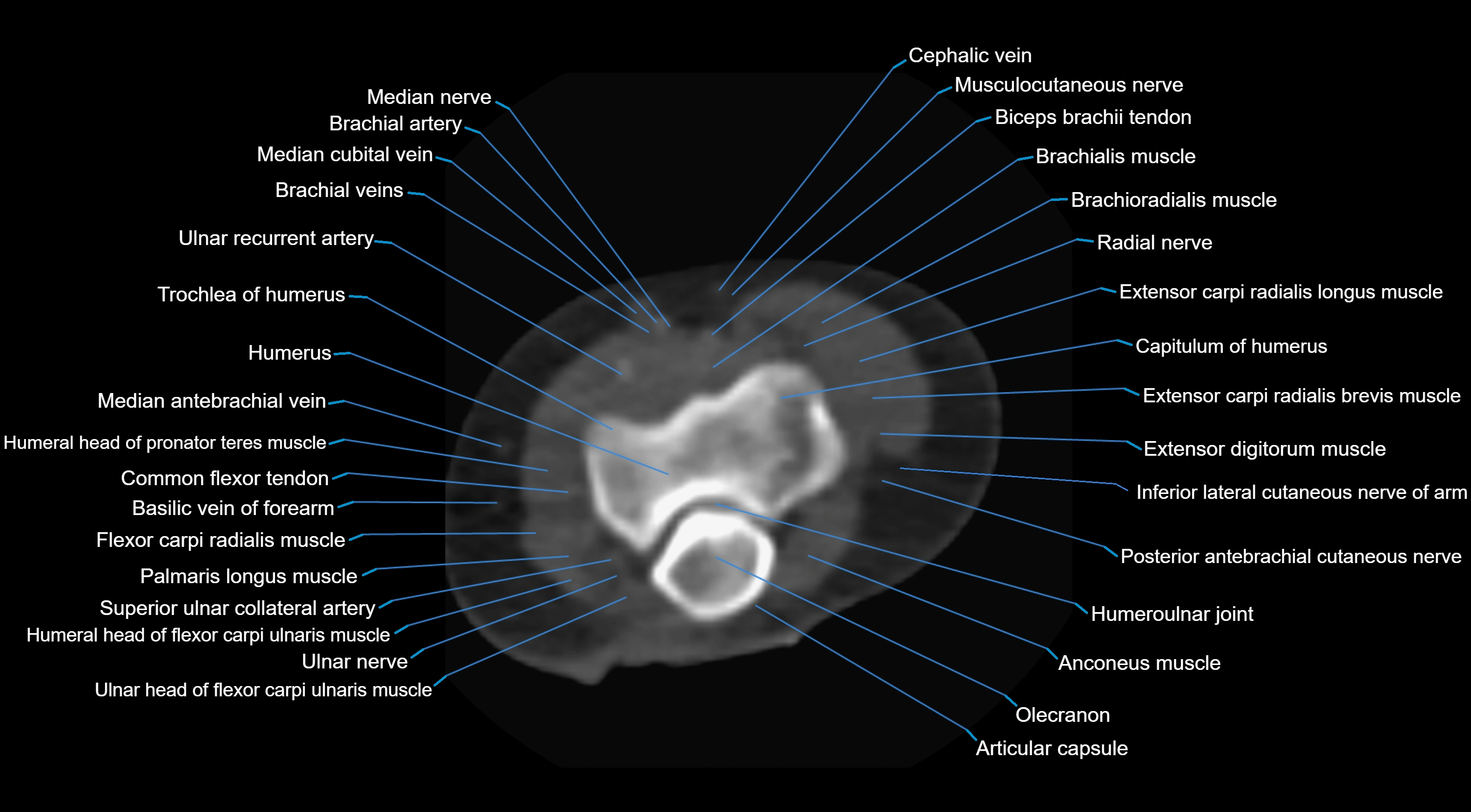 CT elbow axial  cross sectional anatomy labelled  radiology image -00024.webp